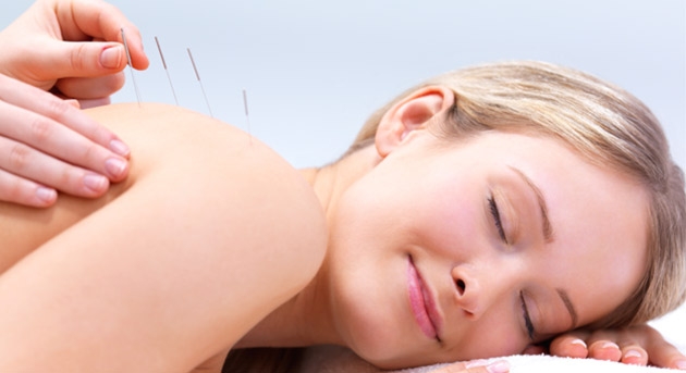 Subsede Sul tem sessão de acupuntura com valor especial